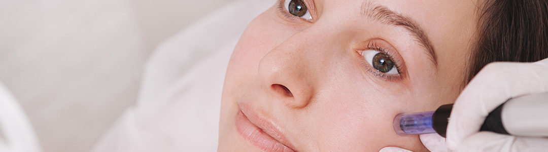 Microneedling