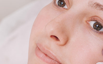Microneedling